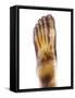 Fractured Foot, X-ray-Du Cane Medical-Framed Stretched Canvas