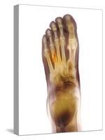 Fractured Foot, X-ray-Du Cane Medical-Stretched Canvas