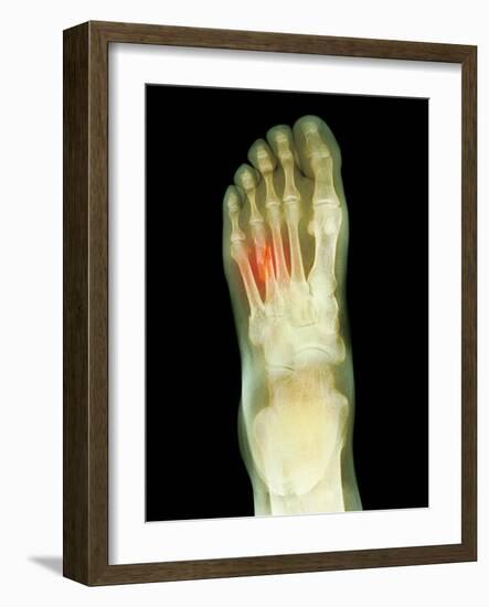 Fractured Foot, X-ray-Du Cane Medical-Framed Photographic Print