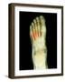 Fractured Foot, X-ray-Du Cane Medical-Framed Photographic Print