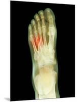 Fractured Foot, X-ray-Du Cane Medical-Mounted Photographic Print