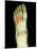 Fractured Foot, X-ray-Du Cane Medical-Mounted Photographic Print
