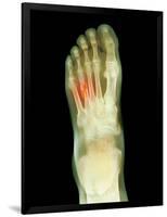 Fractured Foot, X-ray-Du Cane Medical-Framed Photographic Print