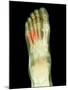 Fractured Foot, X-ray-Du Cane Medical-Mounted Photographic Print