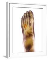 Fractured Foot, X-ray-Du Cane Medical-Framed Photographic Print