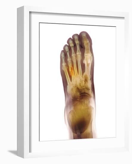 Fractured Foot, X-ray-Du Cane Medical-Framed Photographic Print