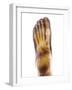 Fractured Foot, X-ray-Du Cane Medical-Framed Photographic Print