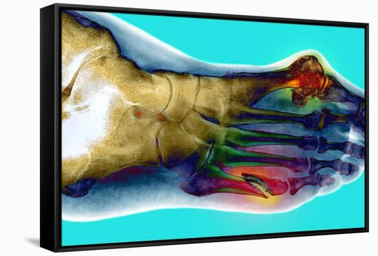 Fractured Foot-Du Cane Medical-Framed Stretched Canvas