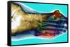Fractured Foot-Du Cane Medical-Framed Stretched Canvas