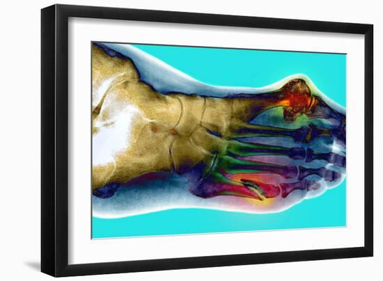 Fractured Foot-Du Cane Medical-Framed Photographic Print