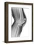 Fractured Kneecap, X-ray-Du Cane Medical-Framed Photographic Print