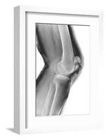 Fractured Kneecap, X-ray-Du Cane Medical-Framed Photographic Print