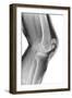 Fractured Kneecap, X-ray-Du Cane Medical-Framed Photographic Print