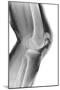 Fractured Kneecap, X-ray-Du Cane Medical-Mounted Photographic Print