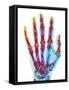 Fractured Palm Bones of Hand, X-ray-Science Photo Library-Framed Stretched Canvas