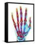 Fractured Palm Bones of Hand, X-ray-Science Photo Library-Framed Stretched Canvas