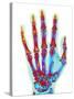 Fractured Palm Bones of Hand, X-ray-Science Photo Library-Stretched Canvas