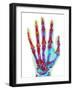 Fractured Palm Bones of Hand, X-ray-Science Photo Library-Framed Photographic Print