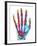 Fractured Palm Bones of Hand, X-ray-Science Photo Library-Framed Photographic Print