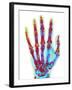 Fractured Palm Bones of Hand, X-ray-Science Photo Library-Framed Photographic Print