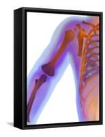Fractured Shoulder, X-ray-Du Cane Medical-Framed Stretched Canvas