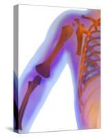 Fractured Shoulder, X-ray-Du Cane Medical-Stretched Canvas