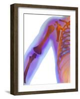 Fractured Shoulder, X-ray-Du Cane Medical-Framed Photographic Print