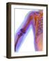 Fractured Shoulder, X-ray-Du Cane Medical-Framed Photographic Print