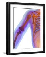 Fractured Shoulder, X-ray-Du Cane Medical-Framed Photographic Print