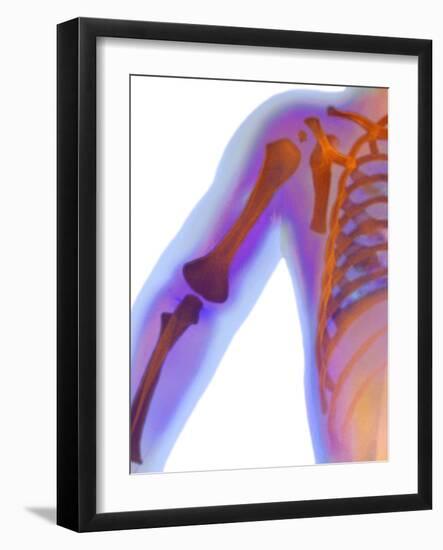 Fractured Shoulder, X-ray-Du Cane Medical-Framed Photographic Print