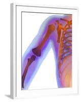 Fractured Shoulder, X-ray-Du Cane Medical-Framed Photographic Print