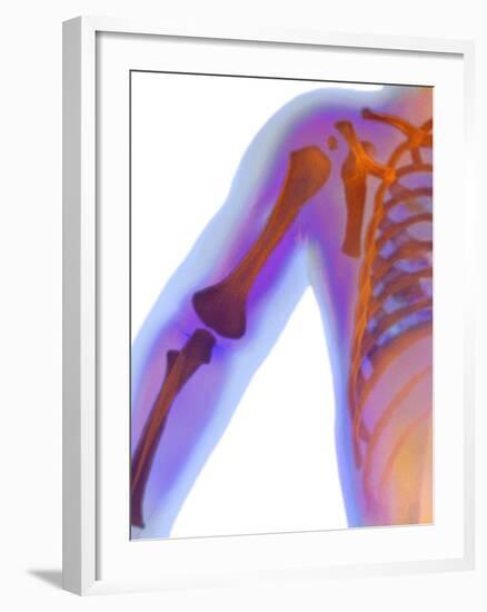 Fractured Shoulder, X-ray-Du Cane Medical-Framed Photographic Print