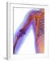 Fractured Shoulder, X-ray-Du Cane Medical-Framed Photographic Print