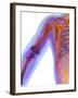 Fractured Shoulder, X-ray-Du Cane Medical-Framed Photographic Print