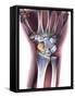 Fractured Wrist, X-ray-Du Cane Medical-Framed Stretched Canvas
