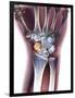 Fractured Wrist, X-ray-Du Cane Medical-Framed Photographic Print