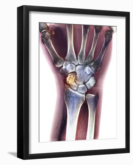 Fractured Wrist, X-ray-Du Cane Medical-Framed Photographic Print