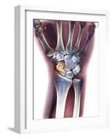 Fractured Wrist, X-ray-Du Cane Medical-Framed Photographic Print