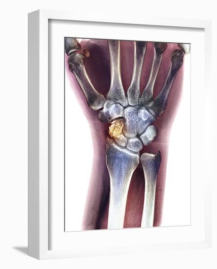 Fractured Wrist, X-ray-Du Cane Medical-Framed Photographic Print