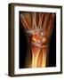 Fractured Wrist, X-ray-Du Cane Medical-Framed Photographic Print