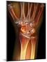 Fractured Wrist, X-ray-Du Cane Medical-Mounted Photographic Print