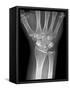 Fractured Wrist, X-ray-Du Cane Medical-Framed Stretched Canvas