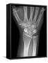 Fractured Wrist, X-ray-Du Cane Medical-Framed Stretched Canvas