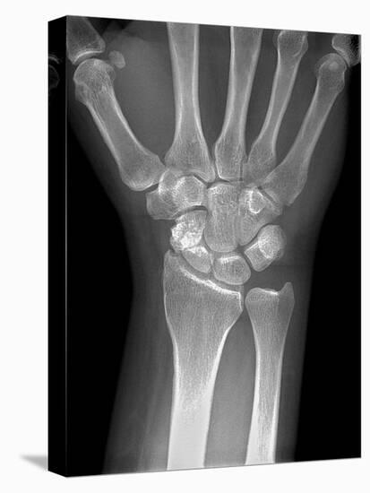 Fractured Wrist, X-ray-Du Cane Medical-Stretched Canvas