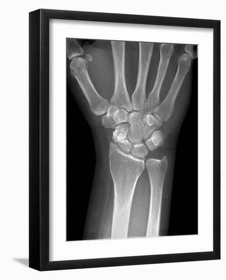 Fractured Wrist, X-ray-Du Cane Medical-Framed Photographic Print