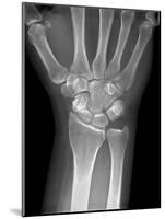 Fractured Wrist, X-ray-Du Cane Medical-Mounted Photographic Print