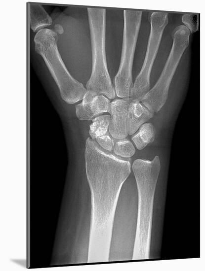 Fractured Wrist, X-ray-Du Cane Medical-Mounted Photographic Print