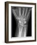 Fractured Wrist, X-ray-Du Cane Medical-Framed Photographic Print