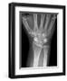 Fractured Wrist, X-ray-Du Cane Medical-Framed Photographic Print