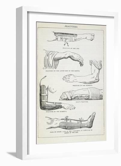 Fractures and Methods Of Bandaging.-Isabella Beeton-Framed Giclee Print